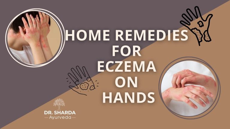 Home Remedies for Eczema on Hands