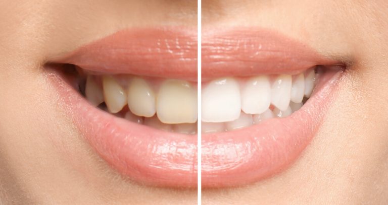 How to Avoid Common Side Effects When Using Dental Bleaching Products How to Avoid Common Side Effects When Using Dental Bleaching Products