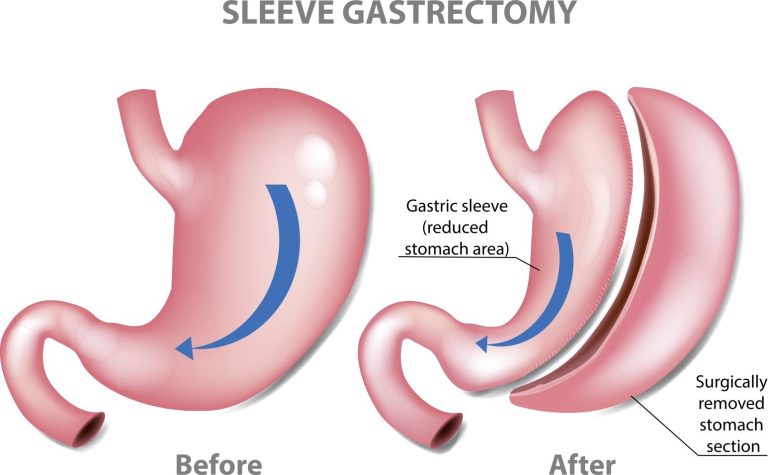 How Bariatric Surgeons Address The Causes Of Easy Weight Gain