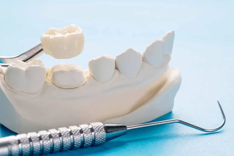 Why Prosthetic Solutions Are Key To Long Term Oral Health