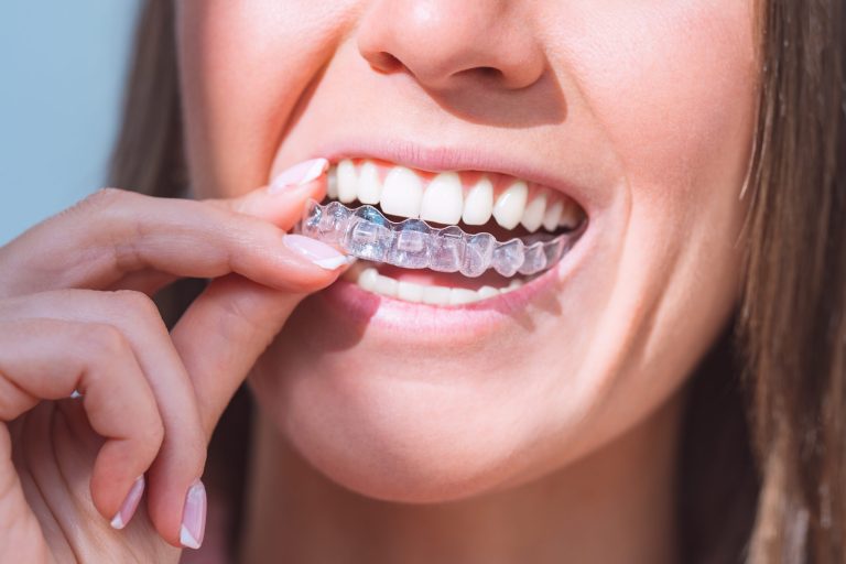 Why Tidal Aligners Are Designed For Comfort And Precision