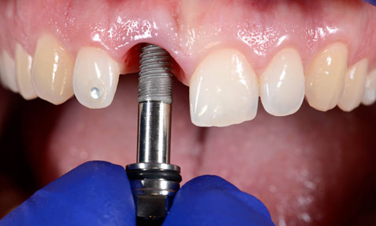 5 Ways Periodontics And Implant Dentistry Transform Oral Health