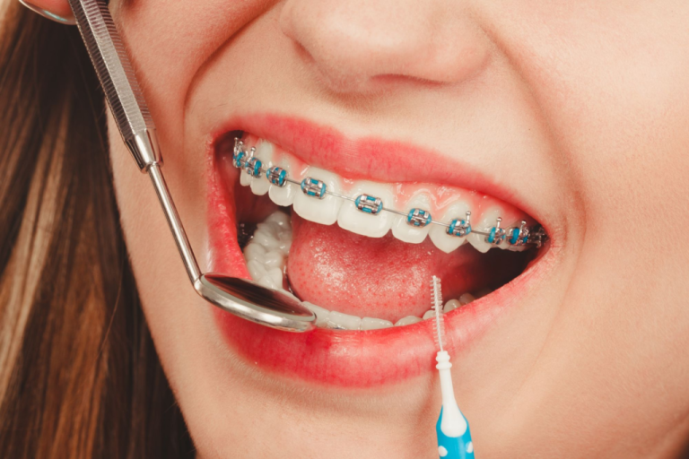 How Orthodontists Personalize Treatment For Every Smile