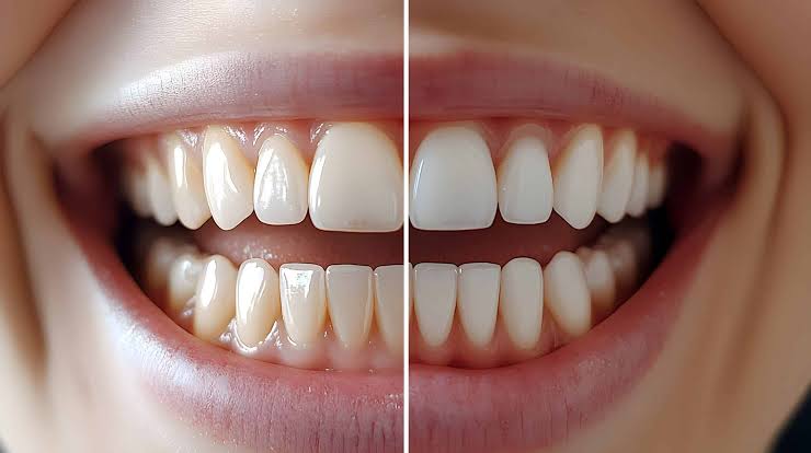 Why Whitening May Be Recommended Before Other Cosmetic Procedures Why Whitening May Be Recommended Before Other Cosmetic Procedures